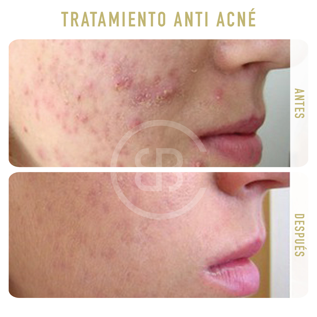 Antes / después Tratamiento anti acné