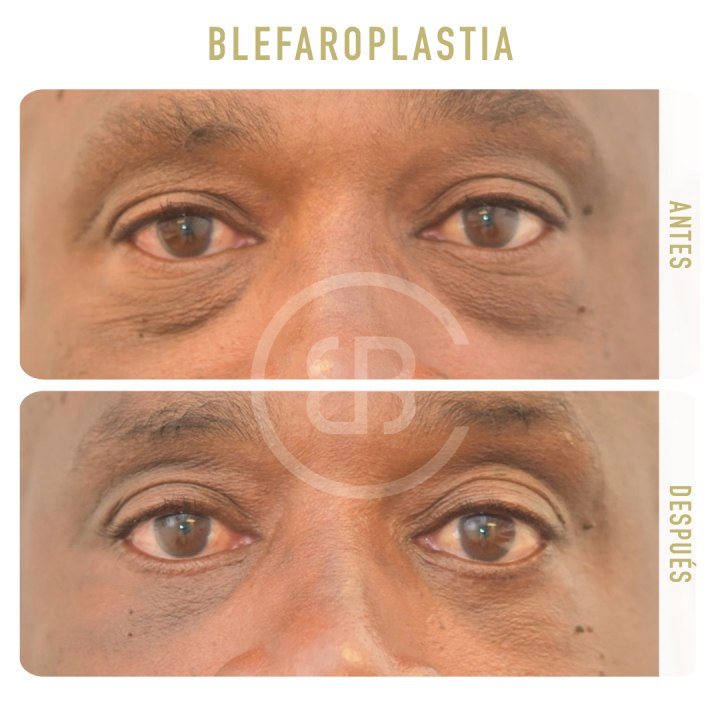 Antes / después Blefaroplastia