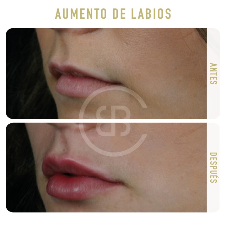 Antes / después Aumento de labios