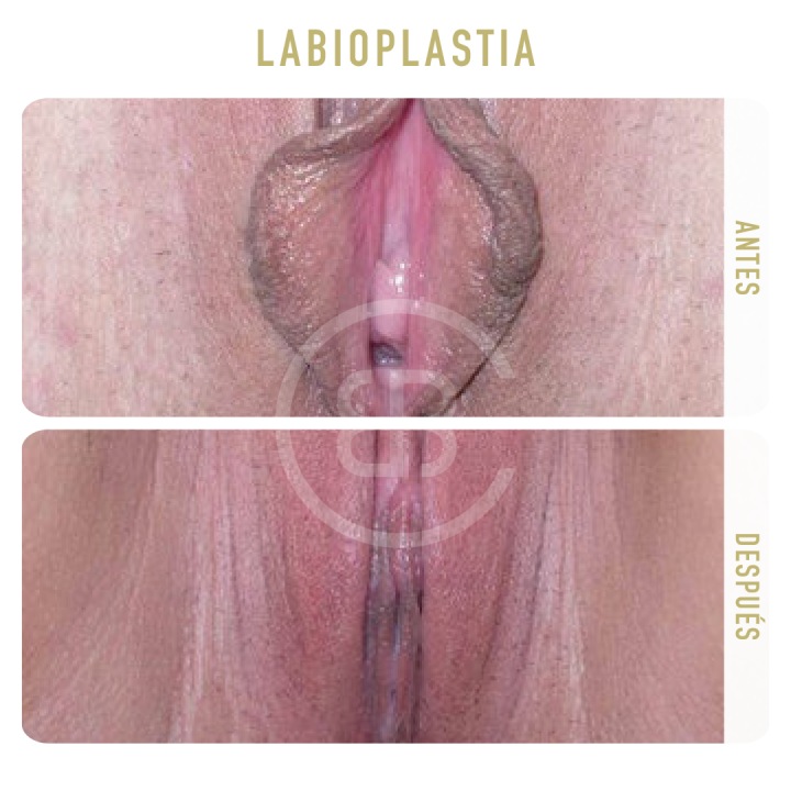 Antes / después Labioplastia
