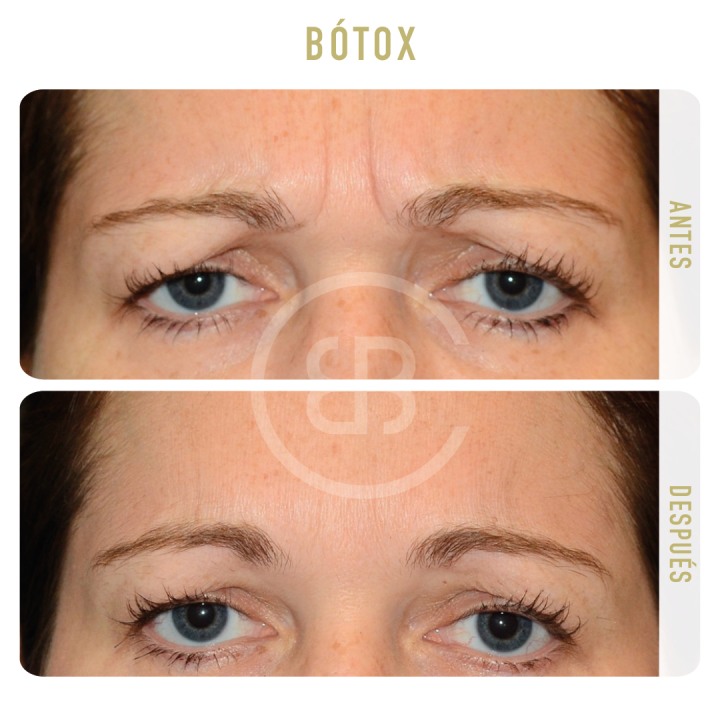 Antes / después Botox