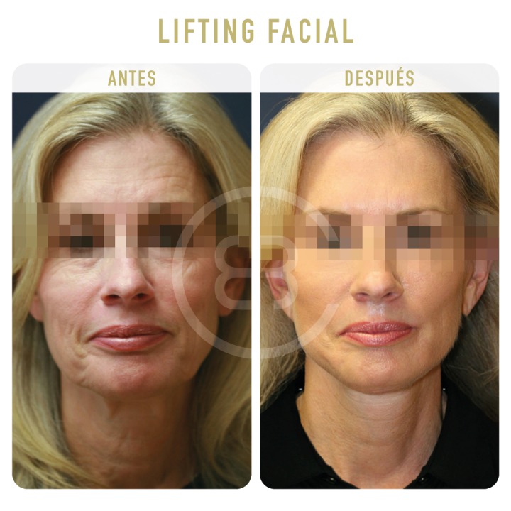 Antes / después Lifting facial